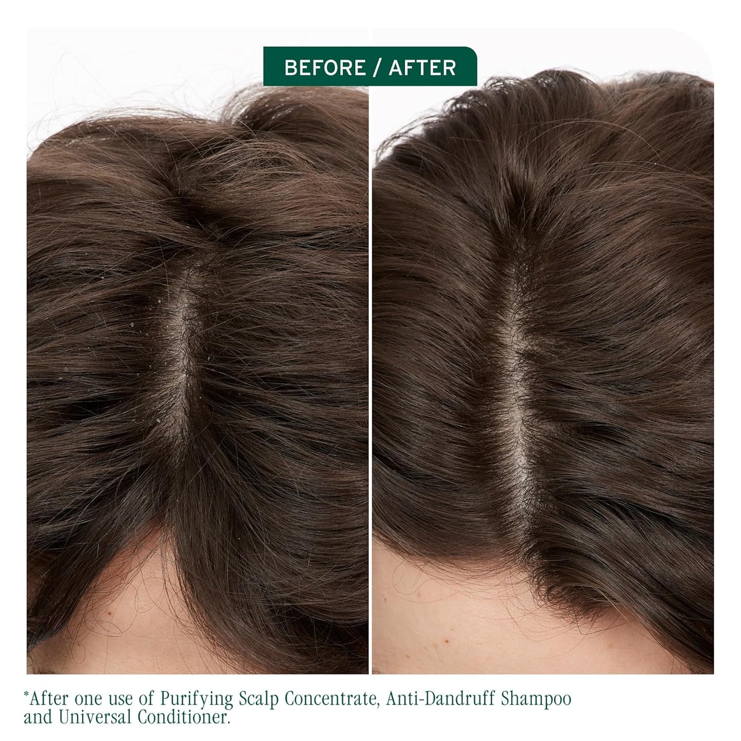 Before and after using Biolage Scalpsync Anti-Dandruff Shampoo