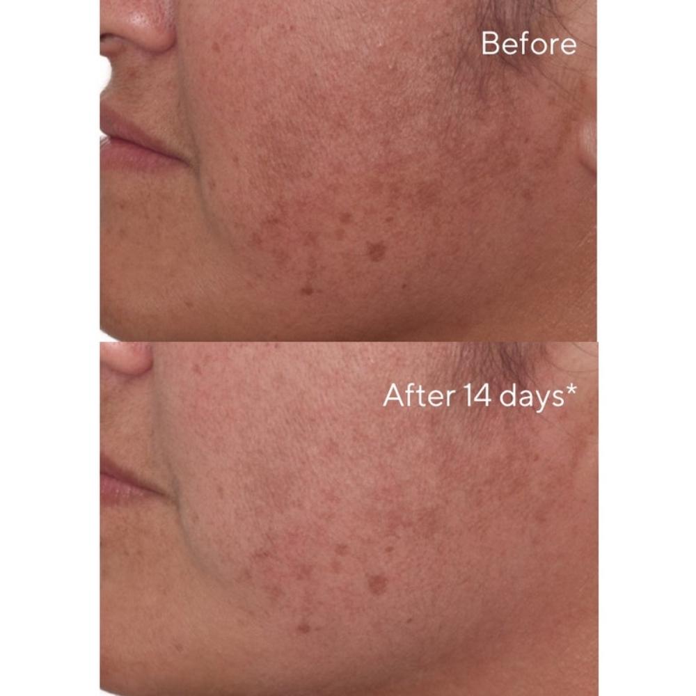 before and after 14 days of use