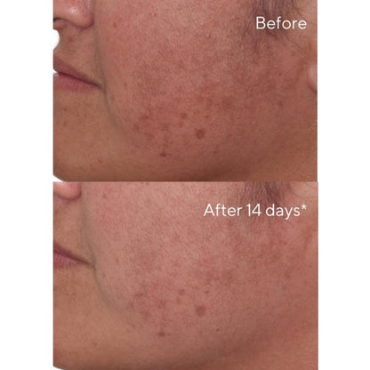 before and after 14 days of use