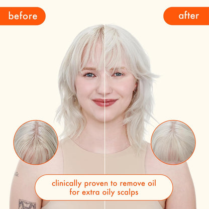 before and after showing less oily hair and scalp. clinically proven to remove oil for extra oily scalps.