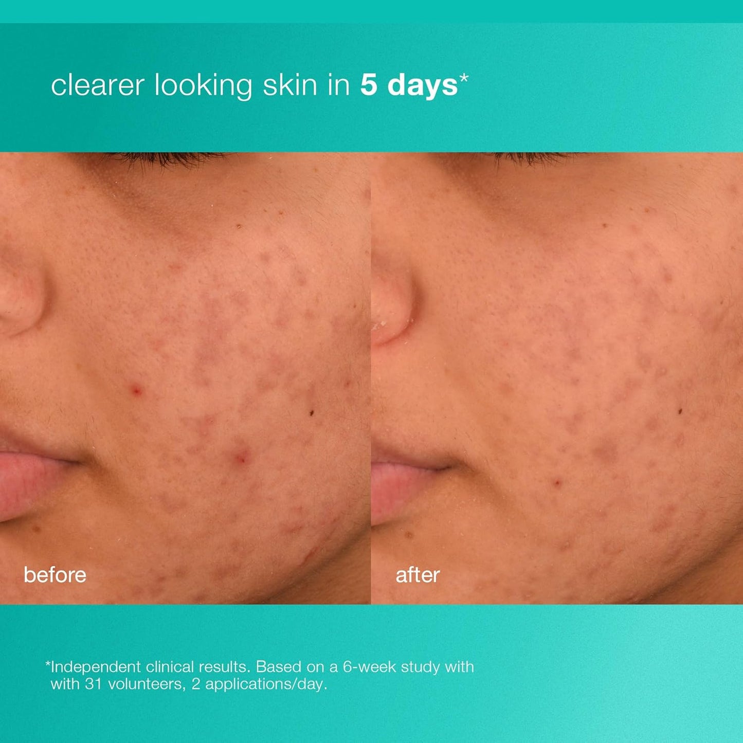 Dermalogica Acne Biotic Moisturizer
