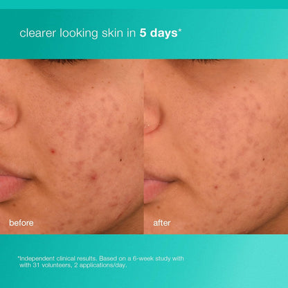 Dermalogica Acne Biotic Moisturizer