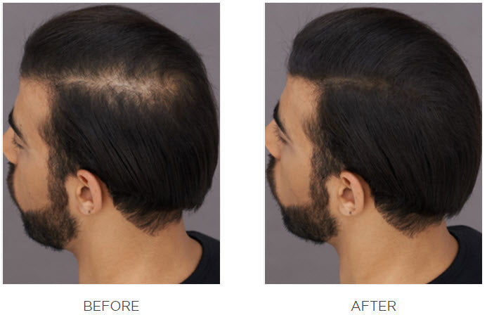 Toppik Hair Building Fibers Before and After