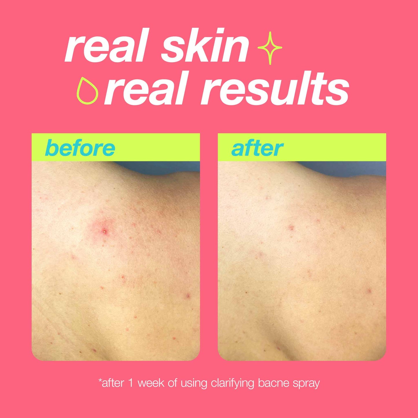 Dermalogica Clear Start Clarifying Bacne Spray before and after 1 week of use results. Clearer and calmer bacne