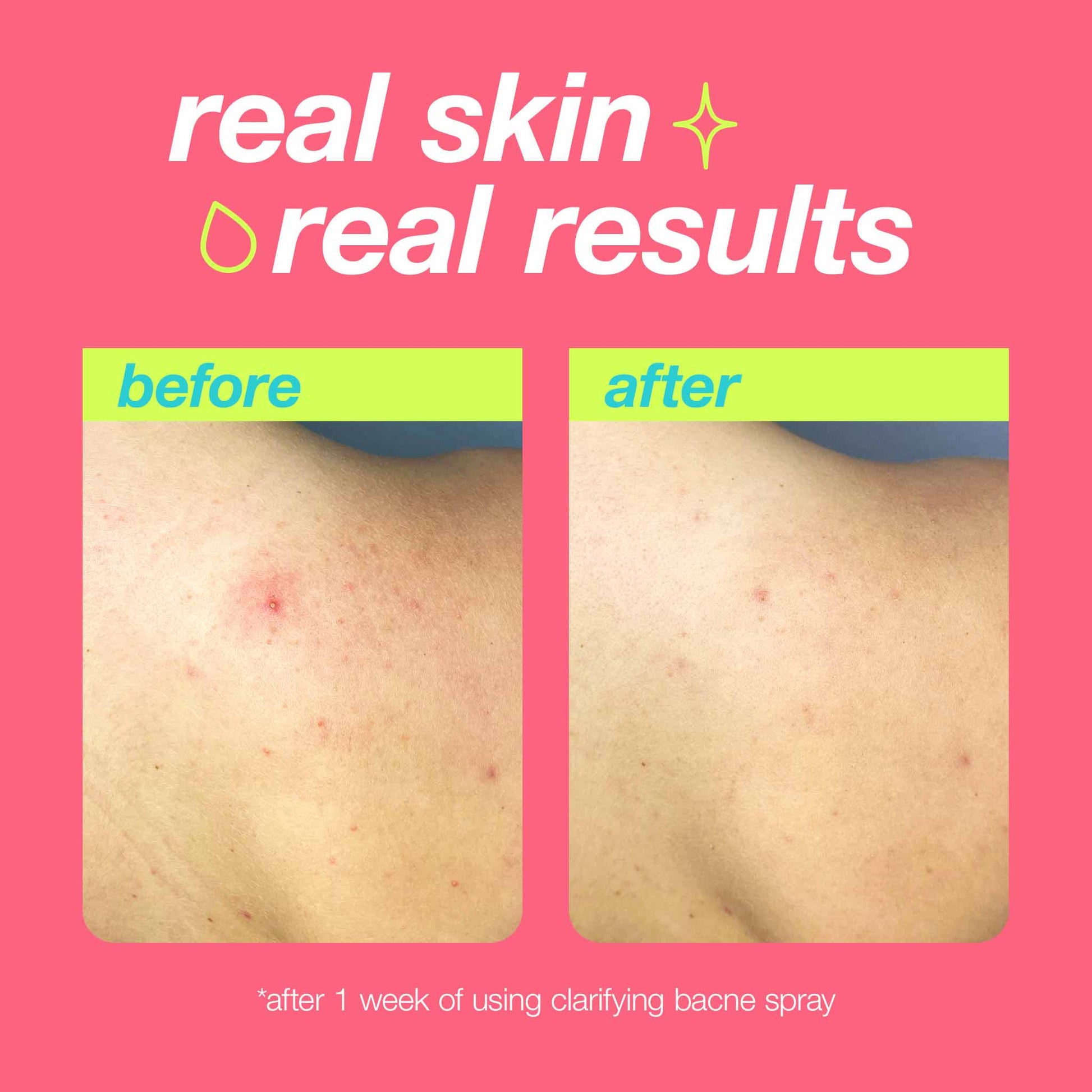 Dermalogica Clear Start Clarifying Bacne Spray before and after 1 week of use results. Clearer and calmer bacne