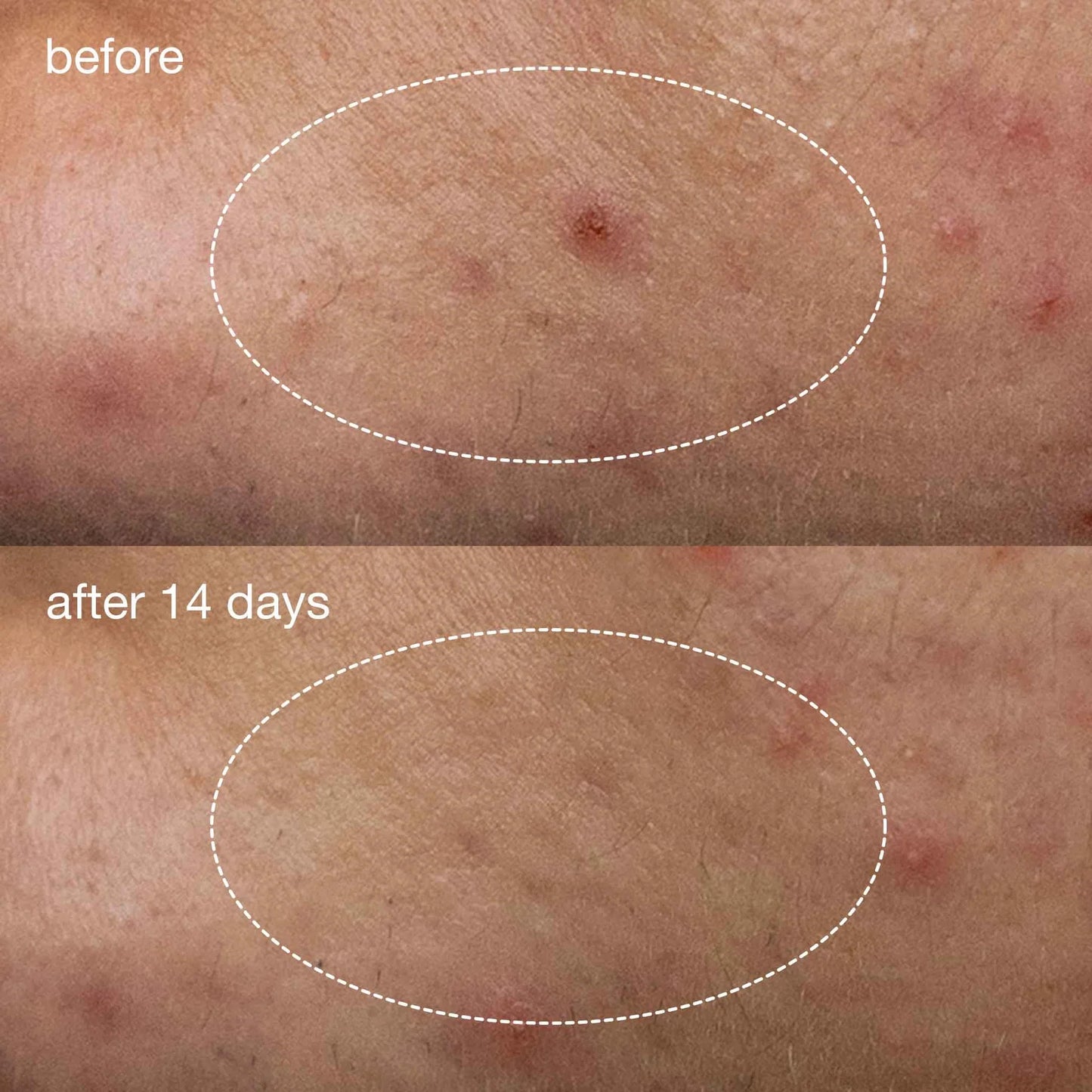 Dermalogica Deep Acne Invisible Liquid Patch can clear deep acne spots after 14 days. Image shows the disappearance of the spot.