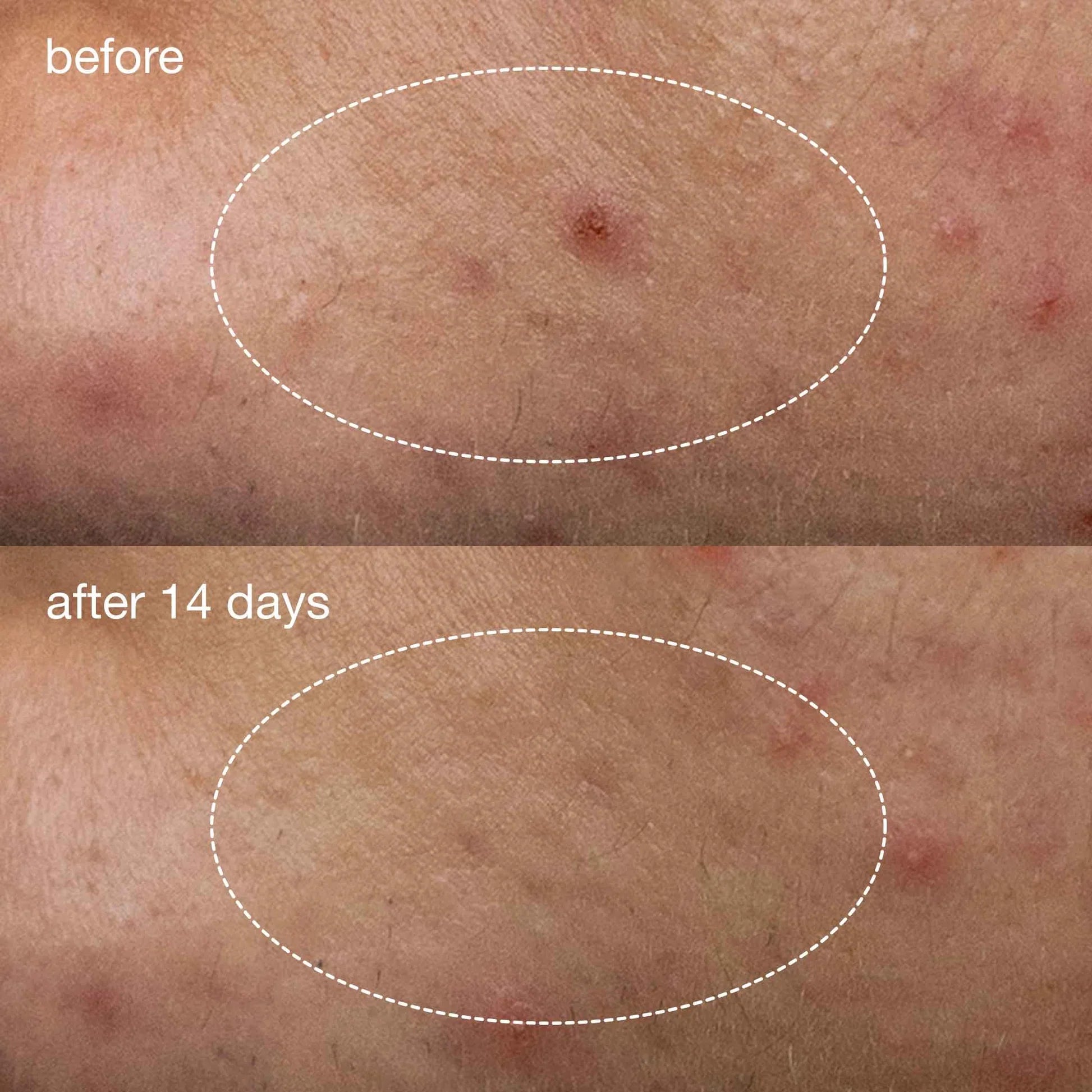 Dermalogica Deep Acne Invisible Liquid Patch can clear deep acne spots after 14 days. Image shows the disappearance of the spot.
