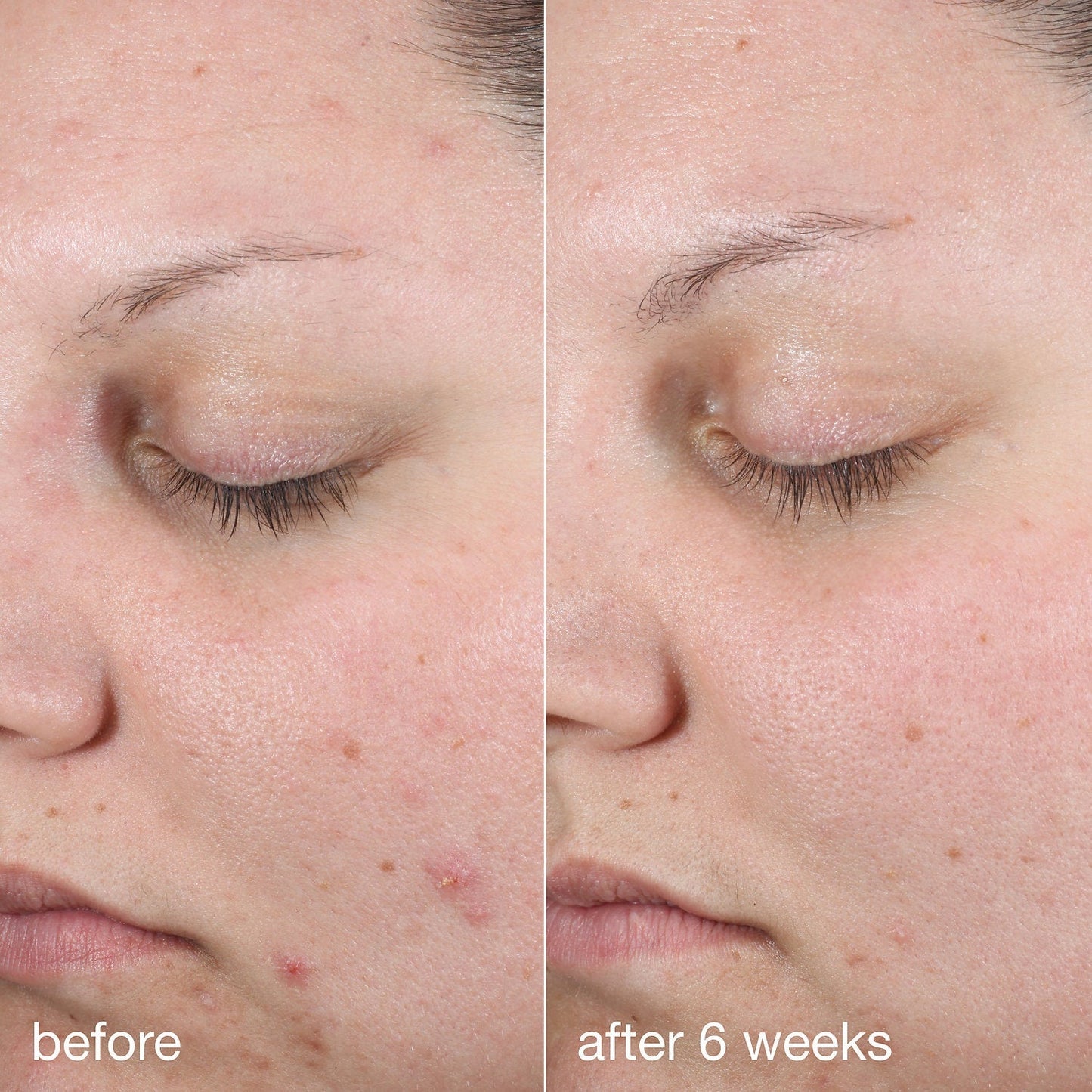 Dermalogica Active Clearing Age Bright Clearing Serum (Before & After)