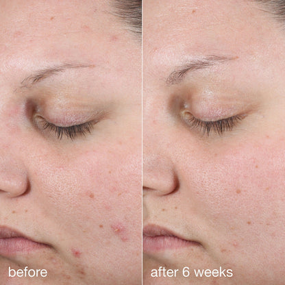 Dermalogica Active Clearing Age Bright Clearing Serum (Before & After)